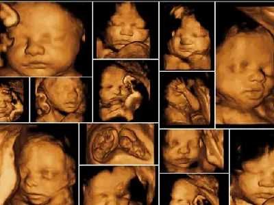 Anomaly Scan Ultrasound During Pregnancy